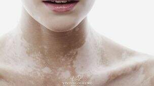vitiligo-o-que-e-e-quais-sao-as-causas-vivian-loureiro