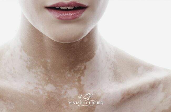 Vitiligo – Entenda o que é