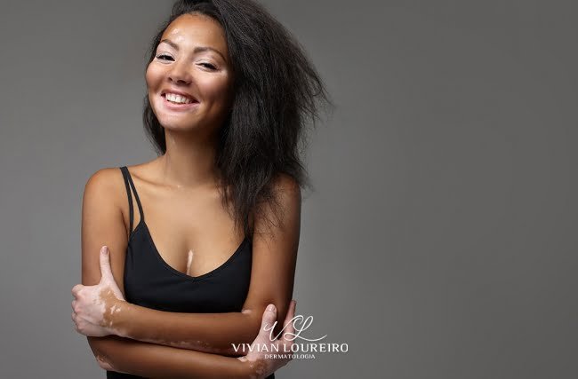 O que é vitiligo e como tratá-lo