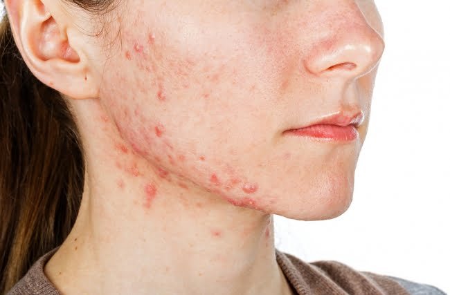 Acne da mulher adulta